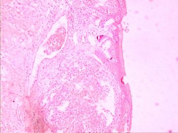 口腔颗粒细胞肌母细胞瘤图5