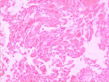 口腔颗粒细胞肌母细胞瘤图6
