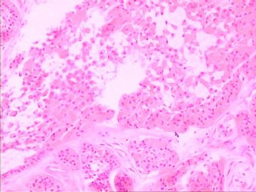 口腔颗粒细胞肌母细胞瘤图7