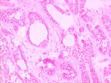 口腔颗粒细胞肌母细胞瘤图8