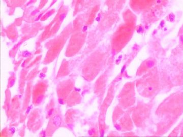 口腔颗粒细胞肌母细胞瘤图9