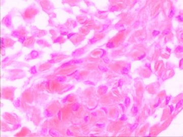 口腔颗粒细胞肌母细胞瘤图10