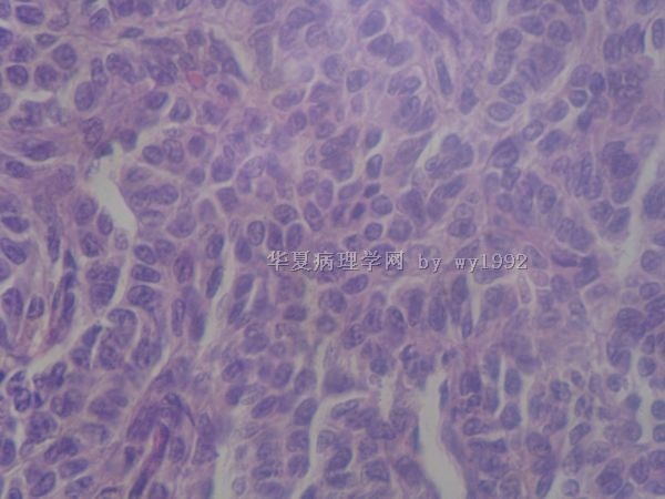 二院091672左卵巢肿瘤图9