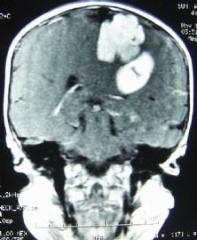 小孩左顶叶肿瘤图35