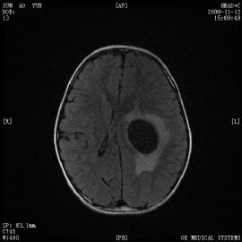 小孩左顶叶肿瘤图46