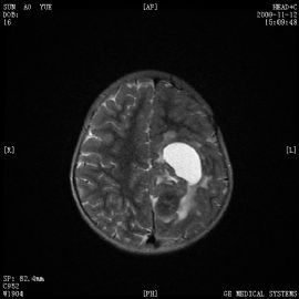 小孩左顶叶肿瘤图47