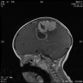 小孩左顶叶肿瘤图50