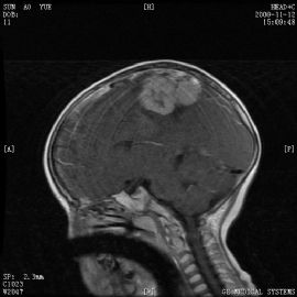 小孩左顶叶肿瘤图51