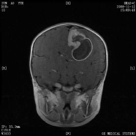 小孩左顶叶肿瘤图52
