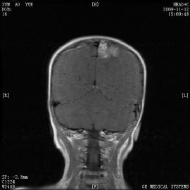 小孩左顶叶肿瘤图54