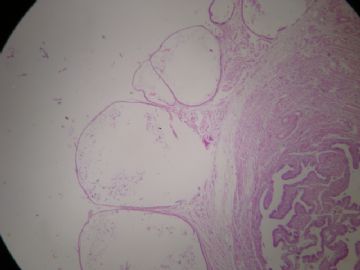 输卵管系膜囊肿，这一类囊肿大家怎么发报告？图1