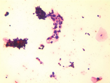 38岁，触血，宫颈液基，H-E染色。图3