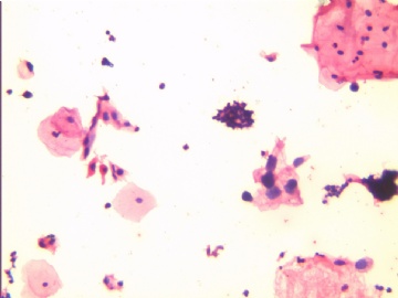 38岁，触血，宫颈液基，H-E染色。图5