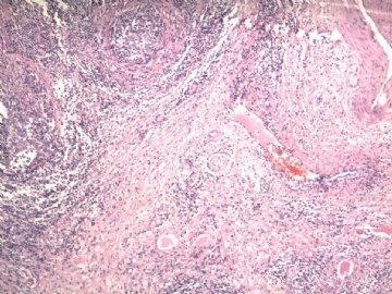左侧附睾肿物图1