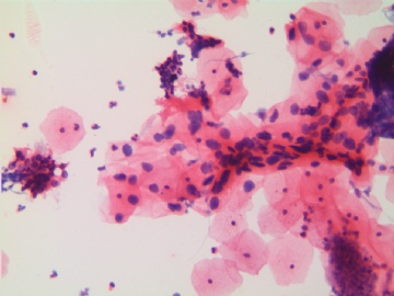 37岁，宫颈液基，H-E染色。图1