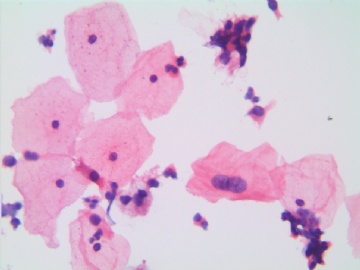 37岁，宫颈液基，H-E染色。图11