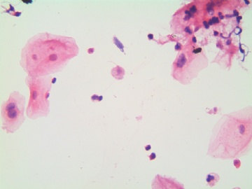 滴虫，H-E染色（宫颈，36岁，国产液基，沉降法）图2