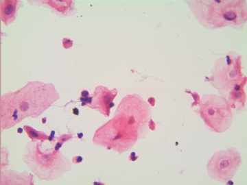 滴虫，H-E染色（宫颈，36岁，国产液基，沉降法）图3
