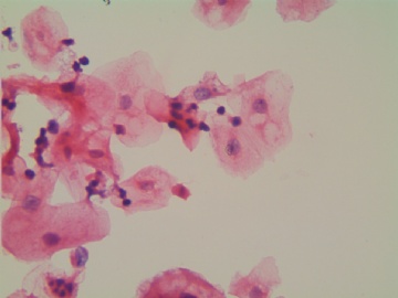 滴虫，H-E染色（宫颈，36岁，国产液基，沉降法）图4