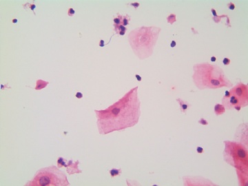 滴虫，H-E染色（宫颈，36岁，国产液基，沉降法）图5
