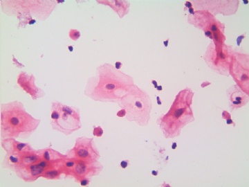 滴虫，H-E染色（宫颈，36岁，国产液基，沉降法）图6