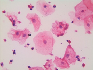 滴虫，H-E染色（宫颈，36岁，国产液基，沉降法）图7