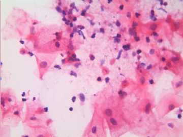 滴虫，H-E染色（宫颈，36岁，国产液基，沉降法）图9