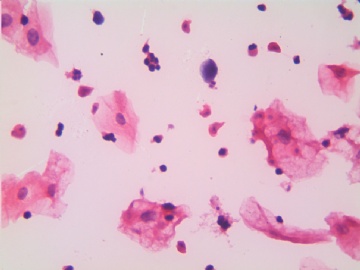 滴虫，H-E染色（宫颈，36岁，国产液基，沉降法）图10