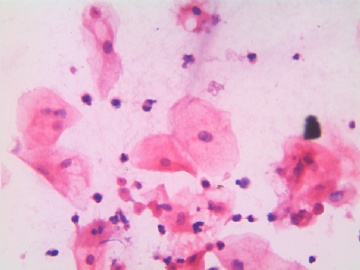 滴虫，H-E染色（宫颈，36岁，国产液基，沉降法）图11