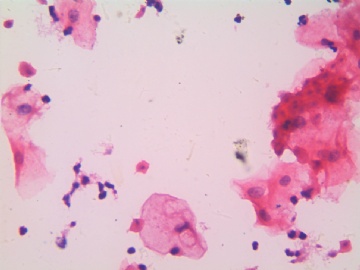 滴虫，H-E染色（宫颈，36岁，国产液基，沉降法）图12