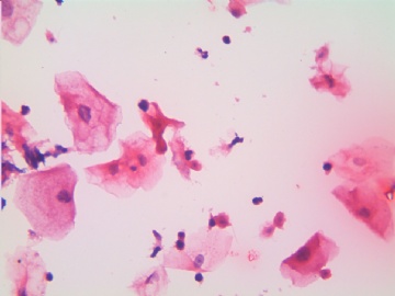 滴虫，H-E染色（宫颈，36岁，国产液基，沉降法）图13
