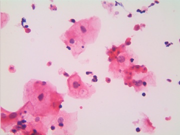 滴虫，H-E染色（宫颈，36岁，国产液基，沉降法）图14