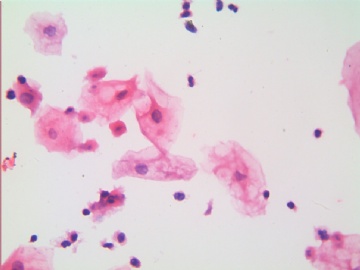 滴虫，H-E染色（宫颈，36岁，国产液基，沉降法）图15