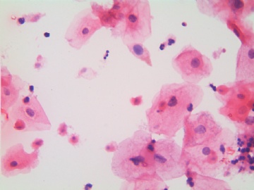 滴虫，H-E染色（宫颈，36岁，国产液基，沉降法）图16