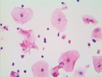 滴虫，H-E染色（宫颈，36岁，国产液基，沉降法）图17