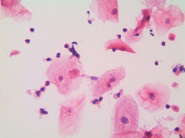 滴虫，H-E染色（宫颈，36岁，国产液基，沉降法）图18