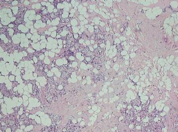乳腺小叶癌or富于脂质的透明细胞癌（07）？图1