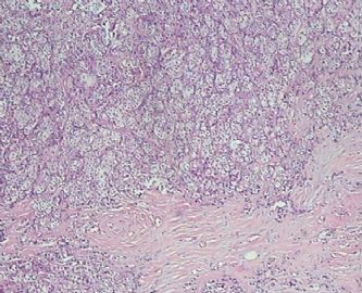 乳腺小叶癌or富于脂质的透明细胞癌（07）？图2