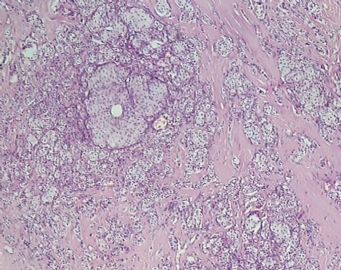 乳腺小叶癌or富于脂质的透明细胞癌（07）？图3