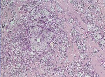 乳腺小叶癌or富于脂质的透明细胞癌（07）？图4