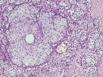 乳腺小叶癌or富于脂质的透明细胞癌（07）？图5
