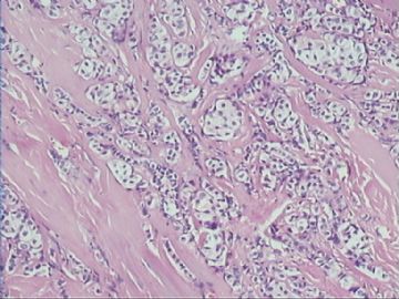 乳腺小叶癌or富于脂质的透明细胞癌（07）？图6