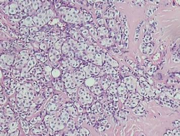 乳腺小叶癌or富于脂质的透明细胞癌（07）？图7