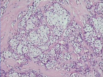 乳腺小叶癌or富于脂质的透明细胞癌（07）？图8