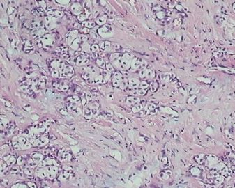 乳腺小叶癌or富于脂质的透明细胞癌（07）？图9