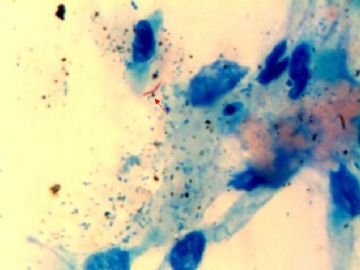 女 46 支气管灌洗液 有癌细胞，但找到了抗酸杆菌图12