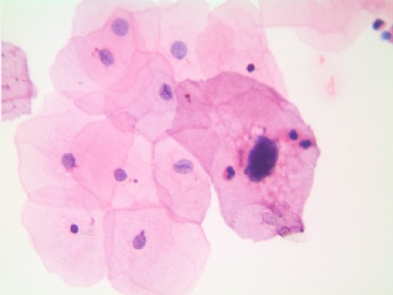 41岁，宫颈液基，H-E染色。图5