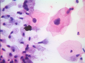 41岁，宫颈液基，H-E染色。图6