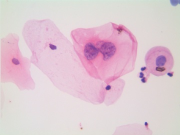 41岁，宫颈液基，H-E染色。图14