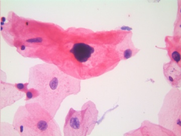 41岁，宫颈液基，H-E染色。图18